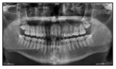 Xquang khớp thái dương hàm chỉ ra vị trí ra trước của lồi cầu.