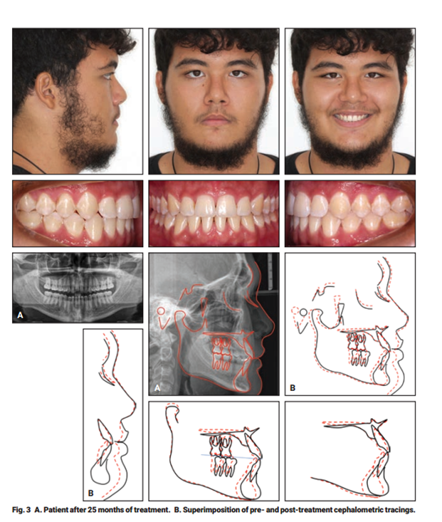 A. Bệnh nhân sau 25 tháng điều trị. B. Chồng phim cephalometric trước và sau điều trị