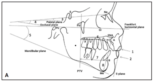 A. Các phép đo xương trên phim cephalometric. 1. Đô nhô môi trên so với mặt phẳng E; 2. Độ nhô môi dưới so với mặt phẳng E; 3. Góc giữa SN và mặt phẳng khẩu cái; 4. Góc giữa Sn và mặt phẳng khớp cắn; 5. Góc giữa mặt phẳng hàm dưới và mặt phẳng Frankfort; 6. Từ A đến PTV; 7. Từ B đến PTV; 8. ENA đến Me.