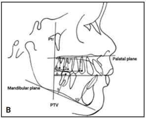 B. Các phép đo răng: Chiều trước- sau hàm trên: 1. PTV đến răng cửa hàm trên; 2. PTV đến trung tâm răng hàm nhỏ thứ nhất; 3. PTV đến trung tâm răng hàm lớn thứ nhất; 4. PTV đến trung tâm răng hàm lớn thứ hai.