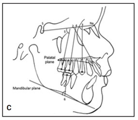 C. Các phép đo góc răng.Hàm trên: 1. PP với trục răng cửa; 2. SNA với trục răng của; 3. SNA với trục răng hàm nhỏ thứ nhất; 4. SNA với trục răng hàm lớn thứ nhất; 5. SNA với trục răng hàm lớn thứ hai.Hàm dưới: 6. MP với răng hàm lớn thứ nhất.