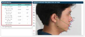 Phân tích khuôn mặt nghiêng - Kết quả phân tích