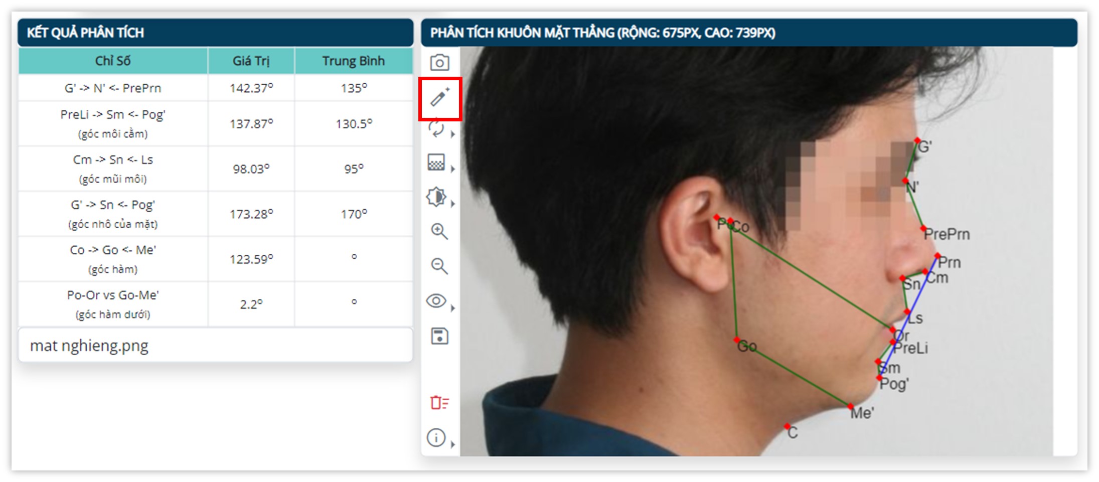 Phân tích khuôn mặt nghiêng - Tự động phân tích