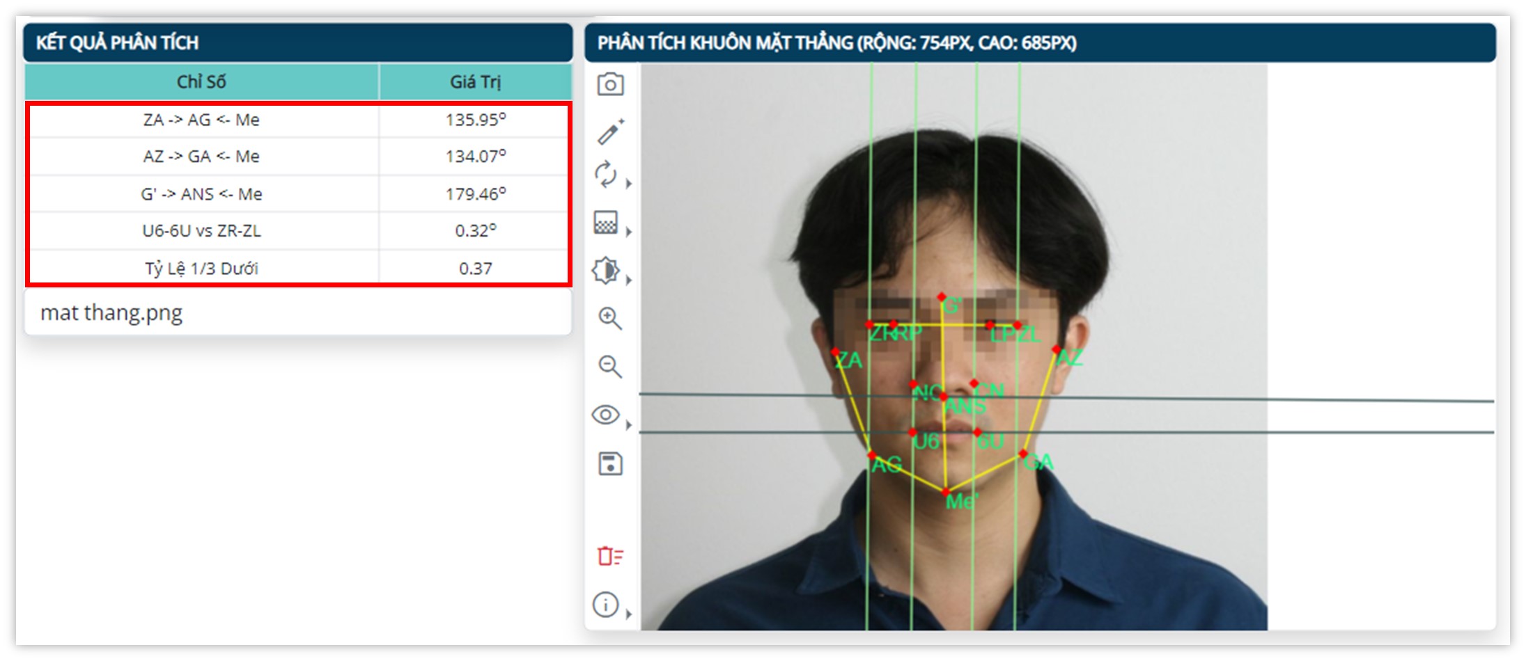 Phân tích khuôn mặt thẳng - Kết quả phân tích