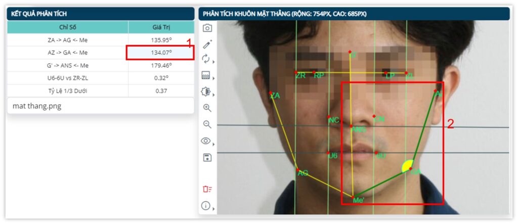 Phân tích khuôn mặt thẳng - Thông số