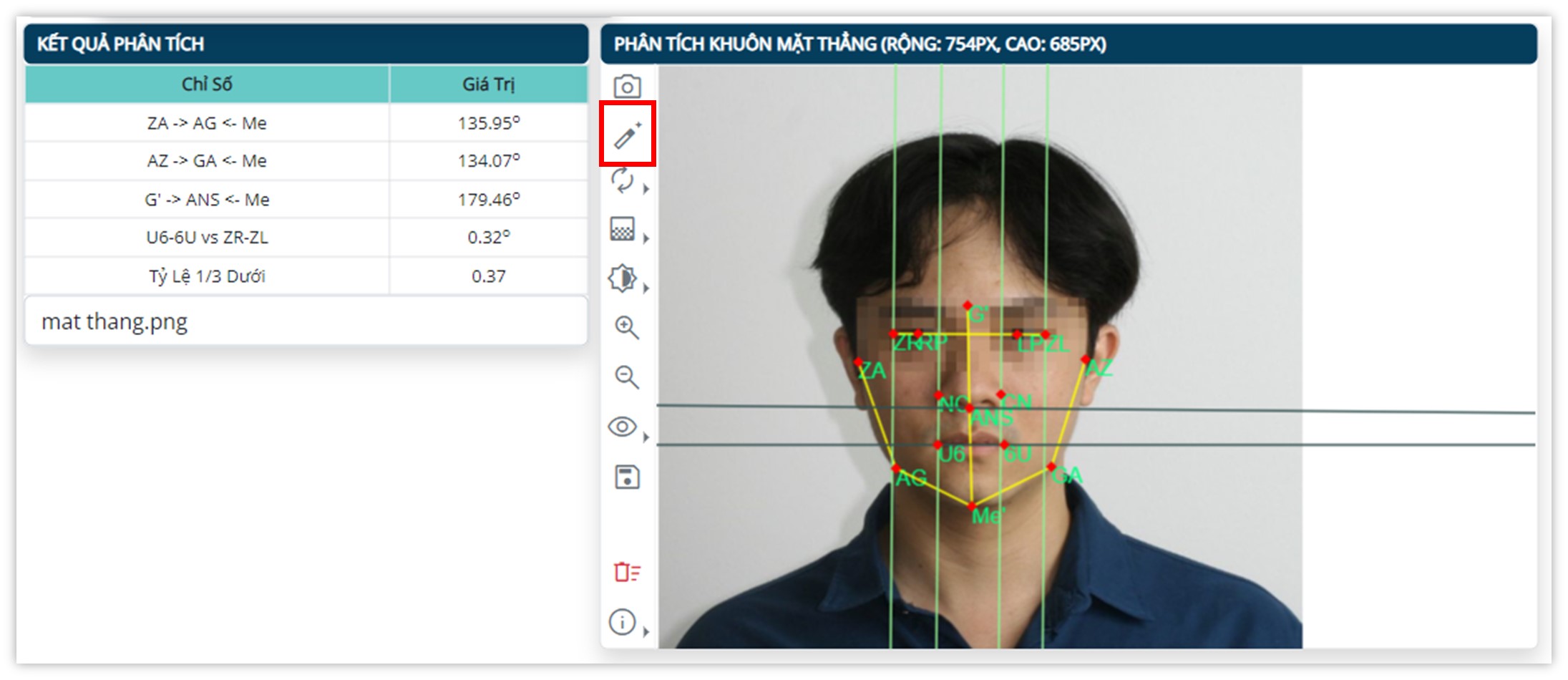 Phân tích khuôn mặt thẳng - Tự động phân tích