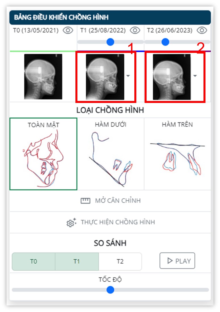 Phân tích phim sọ mặt nghiêng - Chọn phim chồng hình