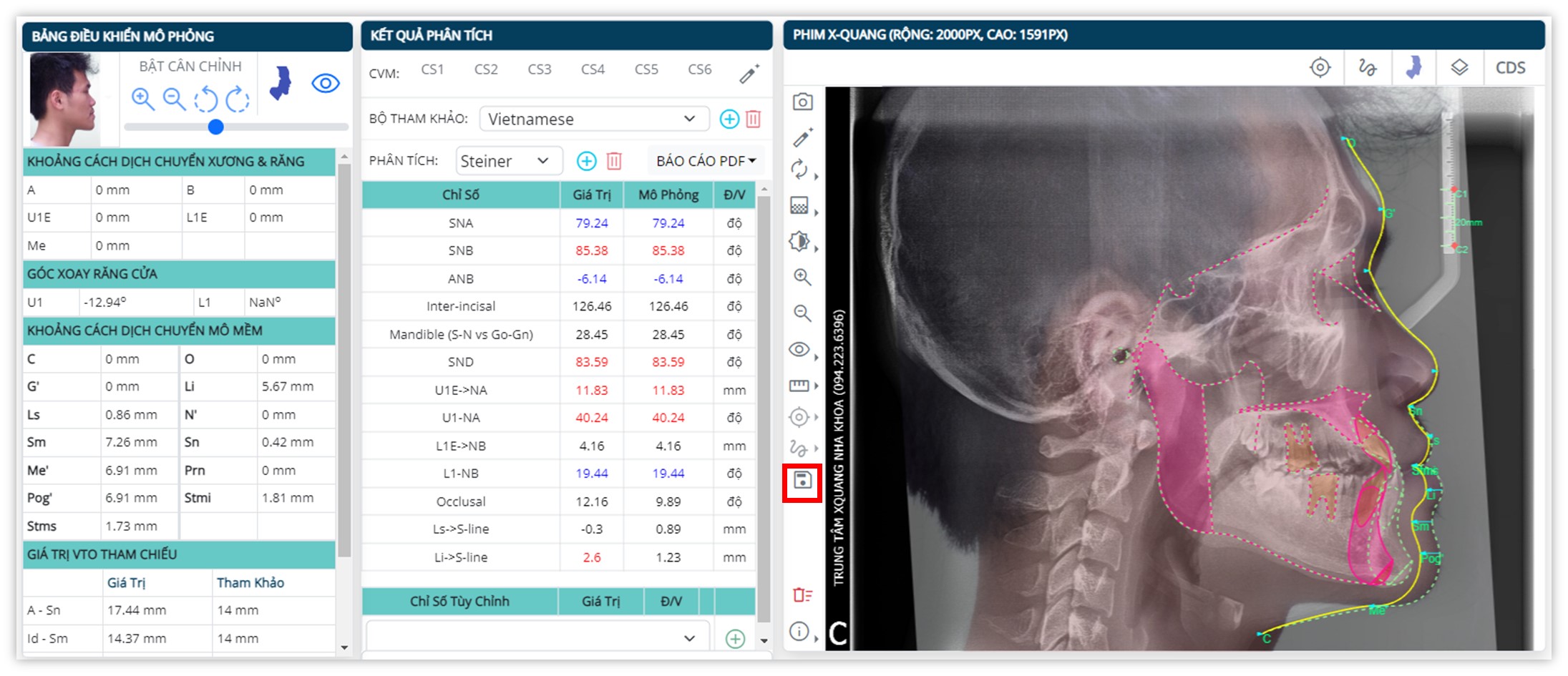 Phân tích phim sọ mặt nghiêng - Lưu mô phỏng điều trị