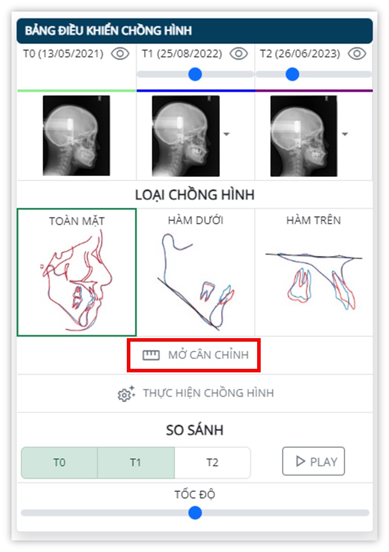 Phân tích phim sọ mặt nghiêng - Mở cân chỉnh