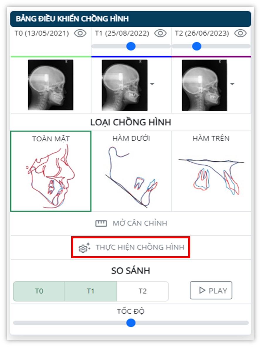 Phân tích phim sọ mặt nghiêng - Thực hiện chồng hình