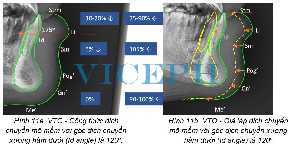 VTO - Giả lập dịch chuyển mô mềm với góc dịch chuyển xương hàm dưới (Id angle) là 120o