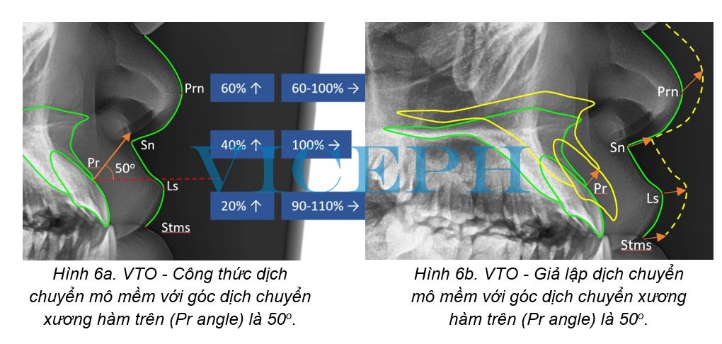 Giả lập dịch chuyển mô mềm với góc dịch chuyển xương hàm trên (Pr angle) là 50o