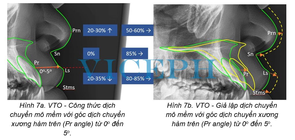 Giả lập dịch chuyển mô mềm với góc dịch chuyển xương hàm trên (Pr angle) từ 0o đến 5o
