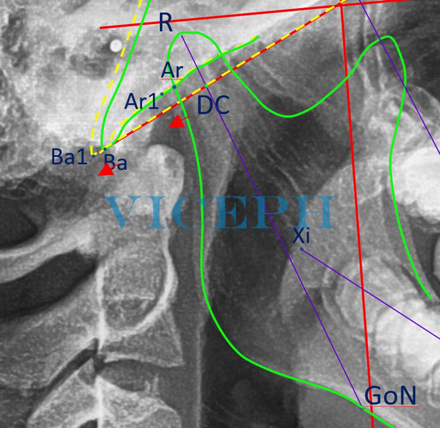 Trục của lồi cầu (condylar axis) chia đôi cổ lồi cầu và nối với điểm sâu nhất hõm trước góc hàm.