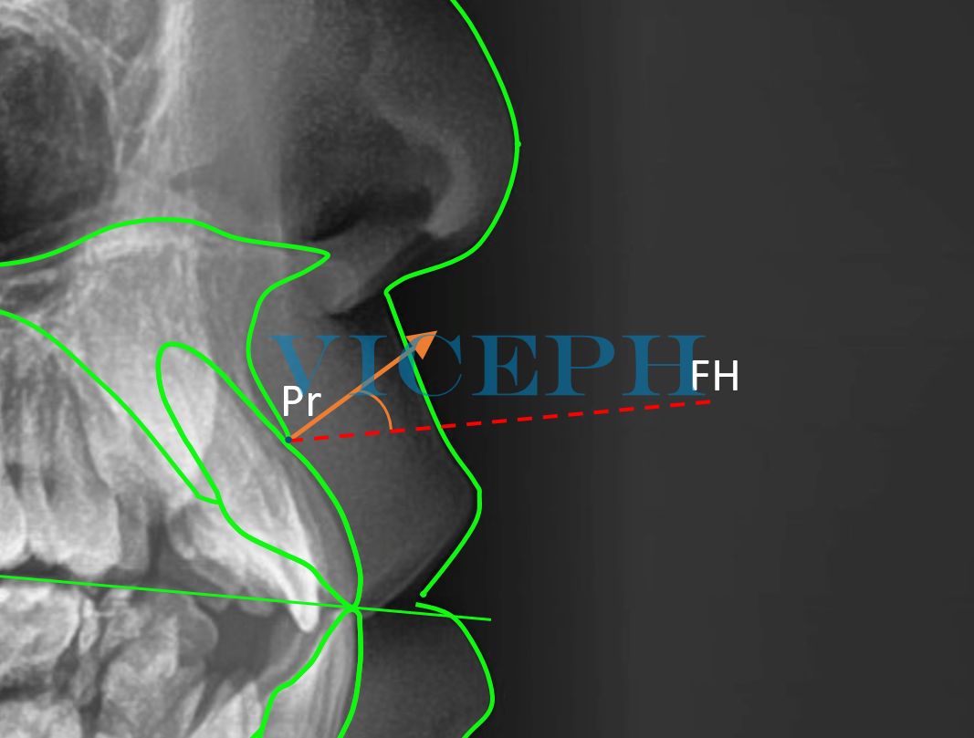 Góc giữa vector dịch chuyển của mào xương ổ răng và mặt phẳng Frankfort