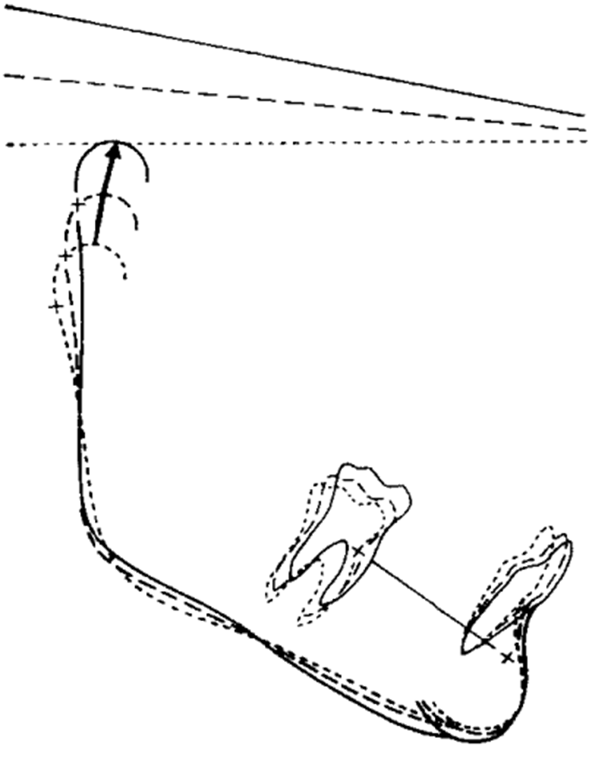 Chồng hình hàm dưới trong phương pháp chồng hình của Bjork