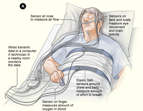 Kỹ thuật Đo đa ký giấc ngủ (PSG) - tiêu chuẩn vàng chẩn đoán OSA