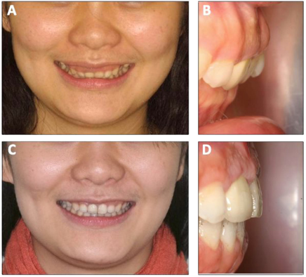 Hình 2. Dựng Torque răng cửa hàm trên thành công, cười hở lợi cũng được giải quyết. (A). Độ hiển thị răng cửa hàm trên trước điều trị. (B). Độ nghiêng của răng cửa hàm trên trước điều trị. (C). Độ hiển thị răng cửa hàm trên sau điều trị. (D). Độ nghiêng của răng cửa hàm trên sau điều trị