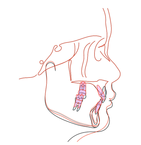 Hình 3. Chồng phim cephalometric cho thấy lún và kéo lui toàn bộ cung răng hàm trên để chữa hở lợi và khớp cắn loại II. Ngoài ra, trồi răng hàm hàm dưới cũng quan sát được do sử dụng bite turbos để nhả khớp. Trươc điều trị (đen); sau điều trị (đỏ)