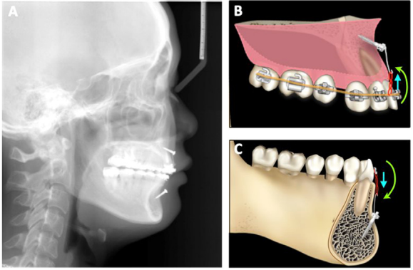 Hình 4. Thiết lập neo chặn trong sai khớp cắn loại II tiểu loại 2 được thể hiện trong các hình từ A đến C. Phim sọ nghiêng (A) cho thấy minivis dưới gò má (IZC) để di xa toàn bộ cung răng hàm trên và minivis vùng răng cửa để điều chỉnh cười hở lợi và mở khớp cắn được minh họa ở hình B và C.