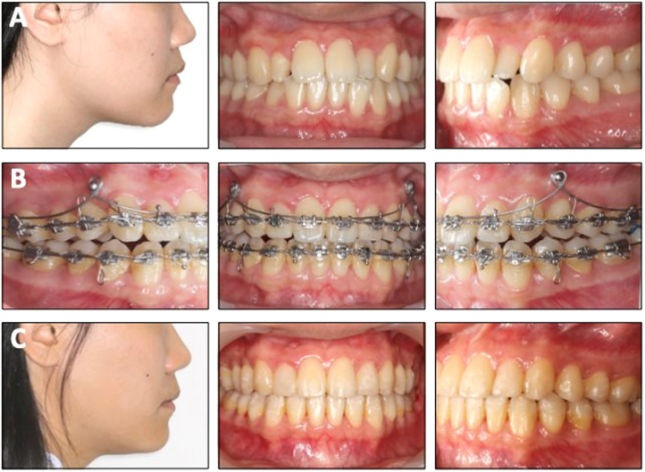 Hình 5. (A) Sai hình xương loại III nhẹ, sai khớp cắn loại I, thiếu độ lộ răng cửa trên. (B) Sau 1 tháng đặt miniscrew neo chặn trồi toàn bộ hàm trên, răng cửa và răng hàm hàm trên trồi do lực khử kích hoạt trên lò xo trồi. (C) Nét nhìn nghiêng sau điều trị thẳng hơn do trồi toàn bộ cung hàm trên và xoay sau hàm dưới 