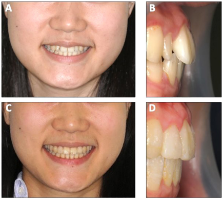 Hình 6. Độ hiển thị của răng cửa hàm trên cải thiện đáng kể sau khi trồi toàn bộ cung hàm trên. (A) Độ hiển thị răng cửa trên trước điều trị. (B) Độ nghiêng răng cửa hàm trên trước điều trị. (C) Độ hiển thị răng cửa trên sau điều trị. (D) Độ nghiêng răng cửa hàm trên sau điều trị